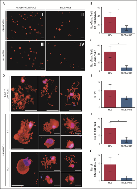 Figure 5. Megakaryocytes (MKs) of the probands exhibit defective SDF1-driven migration on fibrinogen and type I collagen and altered proplatelet formation. (A-C) SDF1-driven migration of MKs was investigated using a Transwell assay. Transwell systems having a polycarbonate membrane with an 8-µm pore size were coated with fibrinogen or type I collagen. Aliquots of 1 × 104 MKs were seeded in the upper chamber of the Transwell insert, whereas the lower chamber was filled with medium containing 100 ng/mL SDF1. After incubation for 16 hours at 37°C and 5% CO2, cells that migrated to the lower face of the membrane were labeled with an anti–β1-tubulin antibody (red) and counted using fluorescence microscopy with an Olympus BX-51 microscope. Samples of the 2 probands were processed in parallel with those of 3 HCs. (A) Representative images of microscopic fields of migrated cells. Scale bars, 30 µm. (B-C) MK migration was quantified as the number of migrated MKs per field (mean ± SD) by analyzing the entire polycarbonate membrane area. The assays were performed in triplicate wells for each condition. (D-G) Proplatelet formation was analyzed on fibrinogen-coated coverslips after incubation of MKs for 16 hours at 37°C and 5% CO2. Cells were stained with an anti–β1-tubulin antibody (red). Hoechst (blue) was used for counterstaining nuclei. Samples of the probands were processed in parallel with those of 3 HCs. (D) Representative images of the morphology of proplatelets extended by probands II-1 and II-2. Proplatelets from HCs are shown in the top row comparison. Scale bars, 30 µm. (E) The rate of proplatelet formation (%PPF) was measured, using fluorescence microscopy, as the proportion of MKs displaying ≥1 proplatelet with respect to the total number of MKs (mean ± SD). The number of proplatelet free ends (tips) (F) and the number of bifurcations of proplatelet shafts (G) per MK were measured using image analysis that investigated ≥25 MKs for each individual (patient or control). *P < .0001, 2-tailed Student t test.