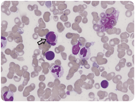 An 8-year-old girl presented with fever, lymphadenopathy, oral ulcers, and gum oozing. She was found to have pancytopenia and prolonged prothrombin time/activated partial thromboplastin time suspicious for acute promyelocytic leukemia. Bone marrow examination showed no evidence of malignancy; however, lupus erythematosus (LE) cells (macrophages that have phagocytized the denatured nucleus of another cell) were noted in the aspirate (black arrow, original magnification ×60, hematoxylin and eosin stain). The patient also tested positive for antiphospholipid antibodies: anticardiolipin immunoglobulin G 75.8 GPL (<23 GPL) and anti-β-2 glycoprotein immunoglobulin G 63.1 GPL (<20.1 GPL). Dilute Russell viper venom time ratio was 1.79 (<1.19), and Staclot difference was 78.8 seconds (<10.7 seconds). Prothrombin level was 12% (reference range 50%-150%), with positive antiprothrombin immunoglobulin G 140.9 units (0-19.9 units). The patient was diagnosed with systemic LE (11/17 Systemic Lupus International Collaborating Clinics criteria) and lupus anticoagulant hypoprothrombinemia syndrome (LAHPS). LE cells are characteristic of autoimmune conditions, although they are not specific to LAHPS or systemic LE. / LAHPS is characterized by the presence of a lupus anticoagulant and an antibody to prothrombin, resulting in both hemorrhagic and thrombotic symptoms. In general, patients respond well to prothrombin complex concentrate, corticosteroids, rituximab, and/or intravenous immunoglobulin. Despite these interventions and a prothrombin level above 50%, the patient died from a large intracranial hemorrhage. The case illustrates a helpful microscopic finding in the bone marrow that may suggest the diagnosis of LAHPS.