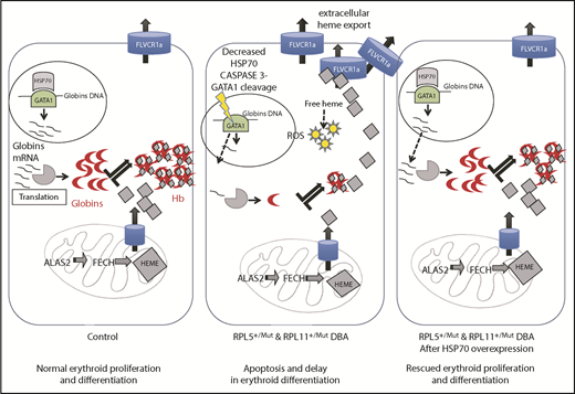 Figure 6. Take home message of this study. Model integrating all of our findings about how HSP70 accounts for the intrinsic defect in DBA by controlling erythroid differentiation and survival in DBA via GATA1, as well as excess free heme, resulting from the imbalanced heme/globin equilibrium.