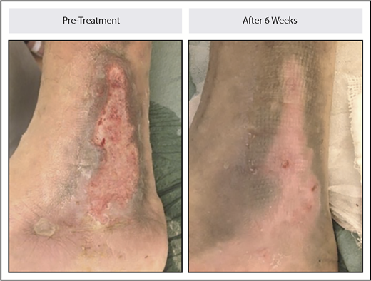 Figure 5. Leg ulcer healing in a patient with non–transfusion-dependent β-thalassemia treated with luspatercept. The patient received 0.4 mg/kg of luspatercept in the initial stage of the study and up to 1.25 mg/kg of luspatercept in the extension stage. The image example shown is representative of an ulcer that healed within 6 weeks.
