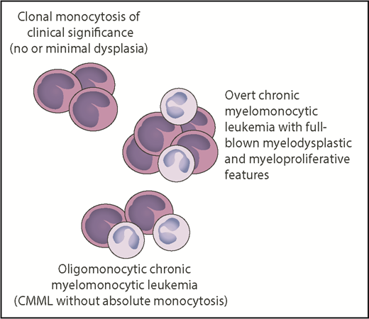 Relationship between clonal monocytosis of clinical significance, oligomonocytic CMML, and overt CMML. The number of monocytes reflects monocytic proliferation, whereas myelodysplasia is represented by neutrophils with hypogranulated cytoplasm and bilobed nucleus. Somatic mutations in genes like TET2, SRSF2, ASXL1, NRAS, KRAS, CBL, or SETBP1 represent the common thread of these chronic myeloid neoplasms, whereas epigenetic factors may be responsible for the phenotypic variability. Professional illustration by Patrick Lane, ScEYEnce Studios.