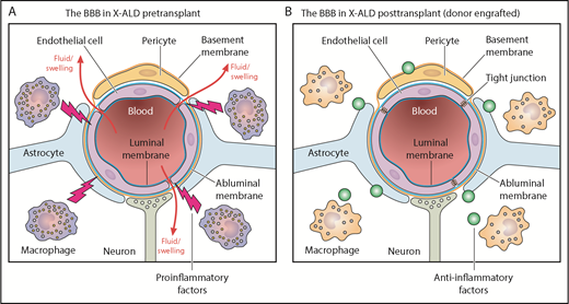 The BBB in X-linked ALD patients before (A) and after (B) hematopoietic cell transplantation. Professional illustration by Patrick Lane, ScEYEnce Studios.