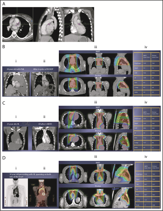Figure 2. Three scenarios of the relation between mediastinal disease and the heart. (A) Showing how to use the takeoff of the left main stem coronary artery (outlined in pink) to determine the upper and lower mediastinal locations. (B) Scenario 1: coronal CT images of a 28-year-old man with primary mediastinal lymphoma before (i) and after (ii) 6 cycles of rituximab, cyclophosphamide, doxorubicin, vincristine, prednisone (RCHOP) chemotherapy presenting for consolidation with radiation. (Biii) Axial, coronal, and sagittal views of an IMRT plan (upper panels) and a proton plan (lower panels). (Biv) Corresponding mean doses to critical structures using IMRT vs protons. (C) Scenario 2: coronal CT images of a 25-year-old man with Hodgkin lymphoma before (i) and after (ii) 4 cycles of doxorubicin, bleomycin, vinblastine, and dacarbazine (ABVD) chemotherapy presenting for consolidation with radiation. (Ciii) Axial, coronal, and sagittal views of an IMRT plan (upper panels) and a proton plan (lower panels). (Civ) Corresponding mean doses to critical structures using IMRT vs protons. (D) Scenario 3: coronal CT images of a 30-year-old man with recurrent Hodgkin lymphoma as shown in the coronal images of a PET/CT scan (i-ii) presenting for definitive radiation. (Diii) Axial, coronal, and sagittal views of an IMRT plan (upper panels) and a proton plan (lower panels). (Div) Corresponding mean doses to critical structures using IMRT vs protons.