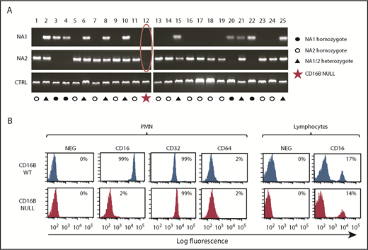 Figure 1. Identification of a rare FcγRIIIB-null donor lacking FCGR3B gene and protein. (A) Genomic PCR was performed on DNA from 25 healthy donors, using primers specific for the HNA1a (NA1) and HNA1b (NA2) allotypes. Jak2 gene was amplified as control. (B) Whole blood from FcγRIIIB WT donors and the FcγRIIIB-null donor was stained with FITC-labeled anti-CD16, anti-CD32, and anti-CD64 antibodies and selected populations, based on scatter properties corresponding to granulocyte and lymphocytes, analyzed by flow cytometry. The data shown are representative of ≥3 experiments.