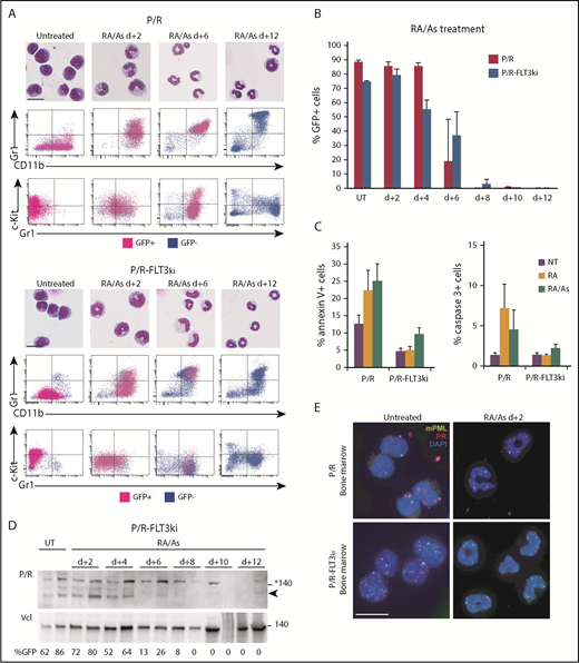 Figure 5. Arsenic drives elimination of FLT3ki APLs. (A) ATRA/As-induced differentiation of P/R (top) and P/R-FLT3ki (bottom) bone marrow cells, as assessed by MGG staining (scale bar 10, µm) and FACS analysis after 2, 6, 8, and 12 days of in vivo treatment. GFP-positive leukemic cells (pink) and GFP-negative normal cells (blue) are shown. (B) Percentages of GFP-positive APL cells in bone marrow of untreated (UT) and ATRA/As-treated P/R (red bars) and P/R-FLT3ki (blue bars) mice at 2 to 12 days posttreatment. (C) Proportion of annexin-V (left) and active caspase-3 (right)-positive spleen cells in APL mice treated for 4 days, as indicated. (D) Western blot of PML/RARA (P/R, arrowheaded) and vinculin (Vcl) expression in the bone marrow of P/R-FLT3ki APL UT and ATRA/As-treated mice from 2 to 12 days. (E) PML NB reformation assessed by immunofluorescence analysis of mPML (green) and human PML/RARA (red) with 4′,6-diamidino-2-phenylindole (DAPI) (blue) in bone marrow cells of P/R and P/R-FLT3ki APL mice treated with ATRA/As after 2 days (scale bar, 10 µm).