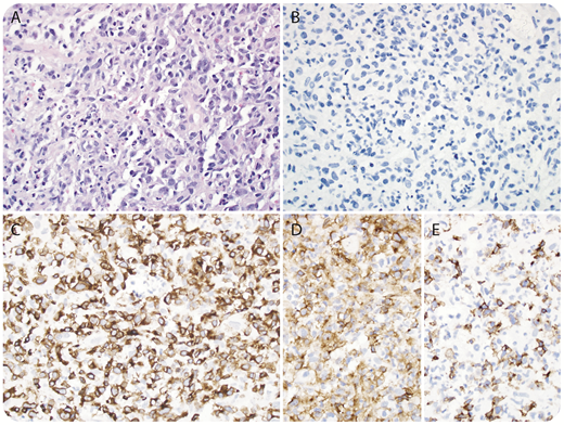 The patient is a 72-year-old man with refractory diffuse large B-cell lymphoma (DLBCL) originally diagnosed more than 10 years ago and treated with fludarabine-based chemoimmunotherapy. He had multiple relapses and achieved a complete response to pembrolizumab plus vorinostat but ultimately relapsed. He was then given CD19-targeted chimeric antigen receptor (CAR) T cells and, within 1 week, he was noted to have an erythematous rash and growing mass on his shin at the site of his known lymphoma, which was suggestive of progressive disease and was biopsied. / The biopsy showed a diffuse, sheet-like infiltrate composed of medium-to-large atypical cells (panel A; hematoxylin and eosin stain, original magnification ×40) suggestive of persistent DLBCL. Stains showed that the infiltrate was negative for B-cell markers, including PAX5 (panel B, original magnification ×40) and positive for CD3 (panel C, original magnification ×40) with predominately CD4 (panel D, original magnification ×40) compared with CD8 (panel E, original magnification ×40). The infiltrate lacked BCL2 (not shown), which is suggestive of T-cell lymphoma. However, 15 days after the biopsy, this lesion completely resolved without intervention, and the positron emission tomography scan confirmed complete remission. This likely represented the CAR T cells that were homing to this particular site but eventually dissipated. These can mimic persistent disease or even a T-cell lymphoma and should be evaluated with caution.
