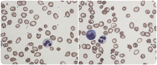 These images were captured from the peripheral blood smear of a 56-year-old patient with Child-Pugh C alcoholic cirrhosis, ongoing alcohol abuse, and chronic macrocytic anemia with baseline hemoglobin 7 to 8 g/dL. Laboratory work suggested a hemolytic process, with a mixed hyperbilirubinemia (total bilirubin 13 mg/dL, direct bilirubin 3.2 mg/dL), low haptoglobin, elevated lactate dehydrogenase, and urinary free hemoglobin. Direct Coombs test was negative. Platelets and white blood cell count were stable at ∼100 000 × 109/L and 9000 × 109/L, respectively. Peripheral smear using the ×100 objective demonstrated a preponderance of acanthocytes with rare schistocytes (panels A-B; Wright stain). / The acanthocytes (spur cells) seen here result from impaired lipid metabolism associated with liver failure. These cells can be differentiated from the echinocytes (burr cells) that are seen in uremia or liver disease by the presence of more uneven, irregular projections. Although acanthocytes typically cause only mild hemolysis, the presence of at least 5% spur cells indicates advanced cirrhosis with a median survival of <3 months. Definitive treatment is directed at the underlying liver disease. Complete resolution of spur cell anemia has been observed following alcohol cessation and liver transplantation. Unfortunately, this patient was not eligible for transplant and expired within weeks of this peripheral smear.