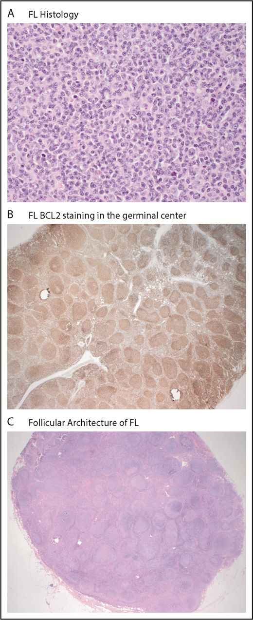 Figure 1. Typical immunohistochemistry of follicular lymphoma. (A) Predominance of small centrocytes in follicular lymphoma (hematoxylin and eosin; original magnification ×400). (B) BCL2 expression in follicular lymphoma (immunohistochemical stain for BCL2; original magnification ×40). (C) Nodal architecture is effaced by follicular lymphoma (hematoxylin and eosin; original magnification ×12.5). Images supplied by Richard Burack, Wilmot Cancer Institute.
