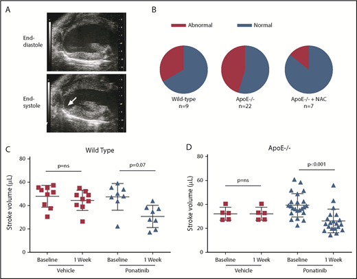 Figure 3. Echocardiographic detection of LV dysfunction. (A) Echocardiography in the parasternal long-axis plane at end-diastole and end-systole illustrating an inferoapical WMA (arrow, see online videos for examples of WMAs). (B) Proportion of animals with segmental LV wall motion abnormalities after 1 week of ponatinib therapy. (C-D) Echocardiographic measurement of stroke volume (bars represent mean ± standard deviation) at baseline and after treatment (vehicle or ponatinib) in wild-type (C) and ApoE−/− mice on a WSD (D). ns, not significant.
