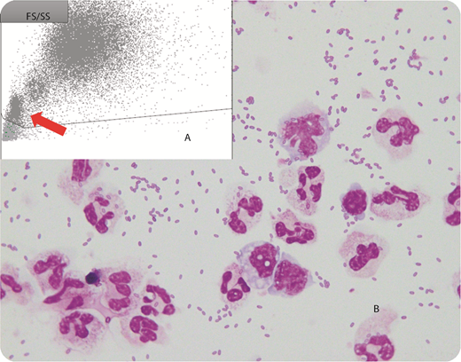 A 69-year-old white woman was evaluated for progressive pancytopenia with fatigue and exertion dyspnea without signs of infection. No organomegaly or signs of sepsis were found. A bone marrow examination revealed dysplasia in all 3 hematopoietic lineages. Flow cytometry was performed, and the forward-scatter/side-scatter chart revealed numerous dots corresponding to small-sized elements (panel A, arrow). The analysis of centrifuged bone marrow cells via cytospin (Romanowsky staining, 100× objective), which is routinely performed in our laboratory and evaluated before flow cytometry, revealed the presence of numerous bacteria, sometimes forming small chains (panel B). Most of these bacteria were extracellular, but some appeared to be inside neutrophils and monocytes. A sample of the bone marrow was evaluated by our microbiology department and gram staining was performed, but the bacteria were absent in their samples. After complete revision of the flow cytometry process, we discovered that the RPMI-1640 stock was contaminated; thus, the presence of bacteria was due to a preanalytical error. / Use of staining to distinguish dead from live bacteria could have been useful in this case. Clinicians and laboratory workers should be aware of this possible preanalytical pitfall to avoid exposing patients to unnecessary and potentially harmful examinations and treatments.
