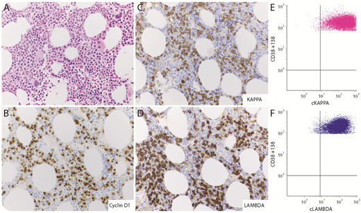 A 69-year-old man with a history of chronic renal failure was evaluated for plasma cell neoplasm and was found to have elevated serum free λ (2845 mg/L; normal, 5-26 mg/L) and κ (127 mg/L; normal, 3-19 mg/L) light chains with a free κ:λ ratio of 0.04 (normal, 0.3-1.7). He had heavy proteinuria (2904 mg/24 hours), and monoclonal free λ light chain was detected by urine immunofixation electrophoresis. No osteolytic lesions or lymphadenopathy were detected by imaging studies. The bone marrow biopsy showed increased plasma cells that made up 30% of the marrow cellularity (panel A, original magnification ×400). They were positive for CD138, cyclin D1 (panel B, original magnification ×400), kappa (κ) (panel C, original magnification ×400), and lambda (λ) (panel D, original magnification ×400) immunohistochemical stains. Aberrant plasma cells with the CD45–, CD38+, CD138+, CD56+/partial, CD117+/partial, CD19+/dim, CD20+/partial immunophenotype were detected by flow cytometry. They were expressing cytoplasmic κ and λ light chains (panels E and F; cKAPPA, cytoplasmic κ light chain; cLAMBDA, cytoplasmic λ light chain). Fluorescence in situ hybridization analysis demonstrated CCND1-IGH rearrangement. The diagnosis of biphenotypic multiple myeloma was rendered. / We present a very rare case of biphenotypic plasma cell myeloma in which the same neoplastic plasma cells expressed cytoplasmic κ and λ light chains with secretion of predominantly free λ light chain. The formation of biphenotypic myeloma could be explained by mutations in the light chain gene because it causes failure in allelic exclusion machinery.