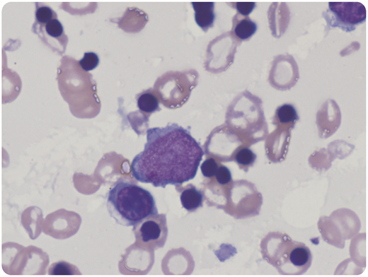 A 64-year-old woman with a 23-year history of JAK2 V617F+ essential thrombocythemia and remote splenectomy experienced progression to myelofibrosis in 2011, which was documented by bone marrow biopsy. Five years later, the peripheral blood is leukoerythroblastic, with 35% myeloblasts and up to 200 nucleated red blood cells (nRBCs) per 100 white blood cells (Wright-Giemsa stain; original magnification ×1000, oil immersion). Dysplastic maturing myeloid forms are also present. Platelets are hypogranular and pleomorphic. The complete blood count has been stable for at least 24 months, with hemoglobin ranging from 8 to 12 g/dL (hematocrit, 26%-35%) and a normal platelet count. The blast count has ranged from 9% to 35%. She has received no transfusions. By conventional criteria (excluding nRBCs in the differential), this qualifies as acute leukemia. However, with limited space for hematopoiesis, the peripheral blood in this unique case is similar to marrow space. When counting nRBCs in the differential, the blast percentage has always been <20%. The protracted clinical course argues against classification of this case as acute leukemia. / In rare cases where hematopoiesis is relegated to the peripheral blood, pathologists should consider including nRBCs in total cell counts when assessing blast percentage.