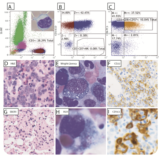 An 80-year-old man with a 20-year history of T-cell large granular lymphocytic leukemia (T-LGL), receiving low-dose neupogen for neutropenia, presented with new-onset fever, pancytopenia, and tachycardia. Flow cytometry of the peripheral blood showed aberrant clonal T cells (6% to 8% of total lymphocytes; panels A-C), CD3+, CD8+, CD7−, CD4−, CD57+ (panel A inset LGL, 100× objective), supporting T-LGL. Bone marrow (BM) biopsy (panel D, 40× objective) and smear (panel E, 100× objective) showed large pleomorphic cells with prominent nucleoli and cytoplasmic vacuoles CD22+ (panel F), PAX5+, CD79A+, MUM1+, CD30+, and CD10− (not shown). T-LGL cells were persistent in the BM, CD3+, CD8+, and CD57+. EBER1 in situ hybridization–positive cells (panel G) supported Epstein-Barr virus (EBV) diffuse large B-cell lymphoma (EBV+ DLBCL), non–germinal center type. Interphase fluorescence in situ hybridization was negative for BCL2, BCL6, and MYC rearrangements. Hemophagocytosis (HLH) was seen on BM smear (panel H, 100× objective), highlighted by CD163 (panel I) on biopsy. Ferritin was 27 519 ng/mL (reference, 30-400 ng/mL); aspartate aminotransferase, 59 U/L (reference, 1-35 U/L); lactate dehydrogenase, 1041 U/L (reference, 100-200 U/L); and fibrinogen, 99 mg/dL (reference, 175-450 mg/dL), supporting HLH. / T-LGL is a rare chronic clonal mature T-cell neoplasm, commonly coexisting with clonal B-cell processes. In this patient, EBV+ DLBCL most likely caused secondary HLH, an ultimate cytokine storm, and immune dysregulation. The patient died soon after.