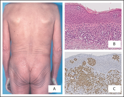 Figure 1. Sézary syndrome. Patient presenting with (A) erythroderma. (B) Band-like infiltrate of atypical lymphoid cells in superficial dermis with formation of intraepidermal (Pautrier) microabscesses. (C) Strong expression of CD279 (PD-1) by neoplastic T cells is a useful marker to differentiate Sézary syndrome from erythrodermic inflammatory dermatoses. Original magnification ×40 (B-C); hematoxylin and eosin (B) and immunoperoxidase (C) stain.