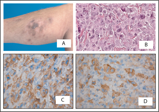 Figure 2. Cutaneous anaplastic large cell lymphoma presenting with multiple skin lesions on the right lower leg. (A) Part disappeared spontaneously. (B) Histologic examination shows a diffuse infiltrate of large anaplastic cells, which are positive for CD30 (C) and show cytoplasmic staining for ALK (D). Staging was negative; initially, an expectant policy was followed. Twelve months after diagnosis, the patient developed systemic disease with involvement of the lungs and bone marrow. Treatment with multiagent chemotherapy was unsuccessful and she died 18 months after diagnosis. Original magnification ×400 (B-D); hematoxylin and eosin (B) and immunoperoxidase (C-D) stain.