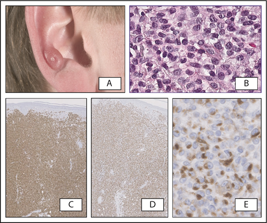 Figure 3. Primary cutaneous acral CD8+ T-cell lymphoma. (A) Typical clinical presentation, with slowly progressive skin tumor on the right ear. (B) Diffuse proliferation of medium-sized pleomorphic cells in the dermis; the atypical cells strongly express CD8 (C) and TIA-1 (D). (E) CD68 shows a positive Golgi dot-like staining. Original magnification ×20 (B,E) and ×40 (C-D); hematoxylin and eosin (B) and immunoperoxidase (C-E) stain.
