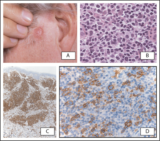Figure 4. Primary cutaneous CD4+ small/medium T-cell lymphoproliferative disorder. (A) Patient presenting with a tumor on the left cheek. (B) Detail of atypical dermal infiltrate showing a predominance of small/medium lymphoid cells and scattered large lymphoid cells, which express CD4 (C). (D) Expression of CD279/PD-1 by medium-sized to large atypical T cells, partly arranged in clusters. Original magnification ×200 (B,D) and ×40 (C); hematoxylin and eosin (B) and immunoperoxidase (C-D) stain.