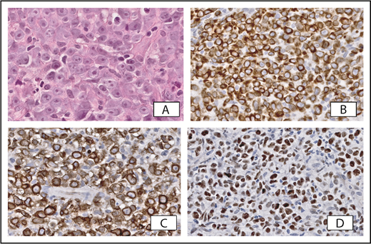 Figure 5. Primary cutaneous diffuse large B-cell lymphoma, leg type. (A) Cohesive sheets of large transformed cells with prominent nucleoli. Strong expression of BCL2 (B), IgM (C), and MYC (D) may facilitate differentiation from PCFCL. Original magnification ×400 (A, hematoxylin and eosin stain) and ×200 (B-D, immunoperoxidase stain).