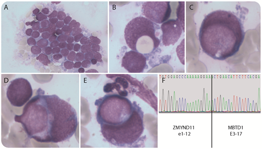 A 19-year-old man was admitted for fatigue without other clinical abnormality. Blood tests showed anemia (115 g/L), thrombocytopenia (81 × 109/L), and 17% blast cells among leukocytes (4.1 g/L). Bone marrow smears revealed infiltration by 90% blast cells mostly organized in small clusters (panel A; May-Grünwald Giemsa stain, original magnification ×500). Rare blast cells showed hemophagocytic activity of erythrocytes or platelets (panel B; May-Grünwald Giemsa stain, original magnification ×1000). More frequently, we have observed 1% to 5% of blast vs blast phagocytic activity, previously referred to as cannibalistic leukemia (panels C-E; May-Grünwald Giemsa stain, original magnification ×1000). Flow cytometry immunophenotyping revealed the following profile: CD45dim/SSClo, CD34+hi, CD38lo/−, CD123+, HLADR−, CD13+/−, CD33+, CD117+, CD7+/−, CD56++. A t(10;17)(p15;q21) translocation was identified. Reverse transcription polymerase chain reaction followed by sequencing confirmed at the messenger RNA level a fusion of ZMYND11 and MBTD1 (panel F). A diagnosis of acute myeloid leukemia (AML) with minimal differentiation was established. Complete remission was obtained with a 3 + 7 regimen. / Whereas hemophagocytic activity of AML blast cells has been well described, especially in cases with a t(16;21)(p11;q22) or t(8;16)(p11;p13) translocation, cannibalistic features are extremely rare in AML and have been described in another case with the same t(10;17) translocation. Further studies are required to understand the link between the ZMYND11-MBTD1 fusion, for which different breakpoints have been described, and the occurrence of “cannibalistic” phenomenon in AML.