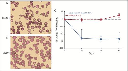 Figure 4. Sickled red cells. Change from (A) baseline (Wright-Giemsa stain) to (B) day 90 (Wright-Giemsa stain) in SCD patients. (C) Percentage of sickled red cells. Relative change from baseline, median, and 25th and 75th percentile; baseline irreversibly sickled cell (ISC) counts ranged from 3.1% to 17.2%. †Represents 5 of 6 subjects at day 90 (D90).