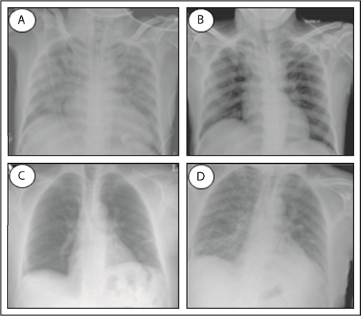 Figure 1. Chest radiographs of a TACO and TRALI patient. Patient at time of TACO occurrence (A), and the same patient after resolution of TACO (B). Pretransfusion patient (C), and the same patient at time of TRALI occurrence (D). Normal chest radiographs without signs of pulmonary edema (B-C); infiltrative changes indicative of pulmonary edema (A,D). Adapted from Agnihotri and Agnihotri110 and Vlaar and Juffermans22 with permission.
