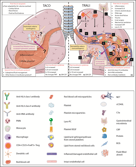 Figure 2. Pathophysiological mechanisms of TACO and TRALI in the lungs. Pathways A-N are systematically discussed in the main text. sCD40L, soluble CD40 ligand; VEGF, vascular endothelial growth factor. This figure was in part created with images adapted from Servier Medical Art by Servier, which is licensed under a Creative Commons Attribution 3.0 Unported License.