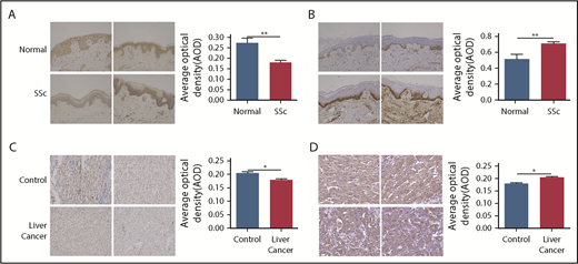 Figure 5. Perls stain and ferritin expression. (A) FGF-6 protein level was evaluated by IHC assay (IHC) in skin tissues from SSc patients and healthy controls (Normal). Staining was visualized by Nikon microscopy; original magnification ×200. A Student t test was used to test for pairwise differences between AOD values between SSc and normal observations. The ratio of positive stain areas to the total area was used to evaluate protein levels. AODs were quantified by ImageJ software. **P < .01. (B) IHC with Perls Prussian Blue stain for ferritin protein was applied to evaluate the iron deposition in SSc skin tissues and healthy skin tissue. AOD values were quantified by ImageJ software. Staining was visualized by Nikon microscopy; original magnification ×200. **P < .01. (C) IHC of FGF-6 protein in liver cancer tissue and control tissue. AODs were quantified by ImageJ software. Staining was visualized by Nikon microscopy; original magnification ×200. *P < .05. (D) IHC of ferritin protein using Perls Prussian Blue stain in liver cancer tissue and control tissue. AODs were quantified by ImageJ software. Staining was visualized by Nikon microscopy; original magnification ×200. *P < .05.