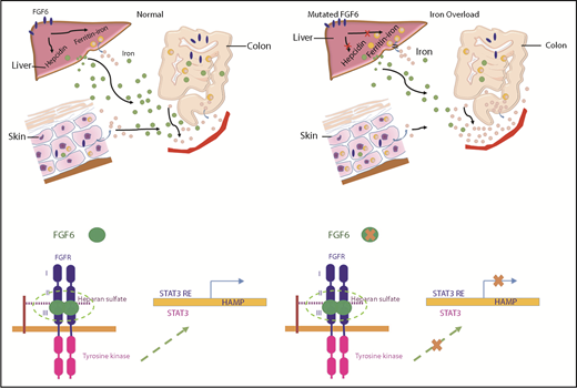 Figure 6. The proposed mechanism of FGF-6 in the regulation of hepcidin expression and iron concentrations. Paracrine FGF-6 interacts with FGFR with heparin or heparin sulfate proteoglycan (HPSG) as the cofactor to initial FGF pathway.59 Activated FGFRs have the ability to phosphorylate specific tyrosine residues and activate STAT3 pathway.60 Iron overload and inflammation could positively regulate hepcidin by BMP/Smad pathway61 and inflammatory IL-6/STAT3 pathways.62,63 However, loss-of-function FGF6 variants will silence the FGF6-FGFR pathway, increase free heparin, and reduce expression of hepcidin, thereby decreasing the inhibition of ferroportin-mediated iron transfer from the intracellular compartment to the blood (ie, increasing plasma levels of iron). In SSc patients, IL-6 is increased so that hepcidin will be positively regulated which suppresses iron release to the plasma generating higher iron levels in skin cells.