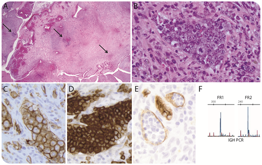 A 28-year-old, otherwise asymptomatic, woman with dysfunctional uterine bleeding was evaluated with hysteroscopic biopsy of a polyp that showed mild stromal chronic inflammation and scattered foci of atypical lymphocytes (panel A: hematoxylin and eosin stain, original magnification ×40; arrows show lymphoid infiltrate). These foci comprised vascular channels filled with large, cohesive pleomorphic, nucleolated lymphocytes (panel B: hematoxylin and eosin stain, original magnification ×400). Immunostains confirmed an intravascular large B-cell lymphoma with high Ki67 index and CD30 expression (panel C: CD20 stain; panel D: CD30 stain; panel E: CD34 stain; all original magnification ×400). CD5, Epstein Barr virus, and HHV8 stains were negative. Immunoglobulin heavy chain by polymerase chain reaction was clonal in FR1/FR2 polymerase chain reaction reactions (panel F); fluorescence in situ hybridization showed no BCL2, BCL6, or MYC rearrangements. / Intravascular large B-cell lymphoma represents an uncommon variant with preferential growth of neoplastic cells within blood vessels, with a median presenting age of 67 years. Two clinical presentations are described: a classical form presenting incidentally or with symptoms related to dysfunction of the affected organ, and a hemophagocytic syndrome-associated form. This case is unusual in its presentation as a benign-appearing endometrial polyp in a young woman. Awareness of this rare, yet aggressive, entity is important because subtle intravascular atypical cell infiltrates may be overlooked at sites, such as the endometrium, where chronic inflammation is common.