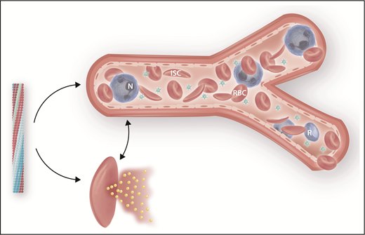 Deoxygenated HbS polymerization is the primary trigger of sickle cell disease pathophysiology, and its inhibition is therapeutically important. Polymerization (left) can be averted by (1) increasing HbF levels; (2) increasing hemoglobin-oxygen affinity, as with voxelator; (3) “rehydrating” the sickle cell, thereby decreasing the concentration of HbS.9 Polymer-damaged sickle erythrocytes cause vaso-occlusion (top) and hemolysis, a portion of which occurs intravascularly (bottom). ISC, irreversibly sickle cell; N, neutrophil; R, reticulocyte; RBC, sickle erythrocyte. Professional illustration by Somersault18:24.