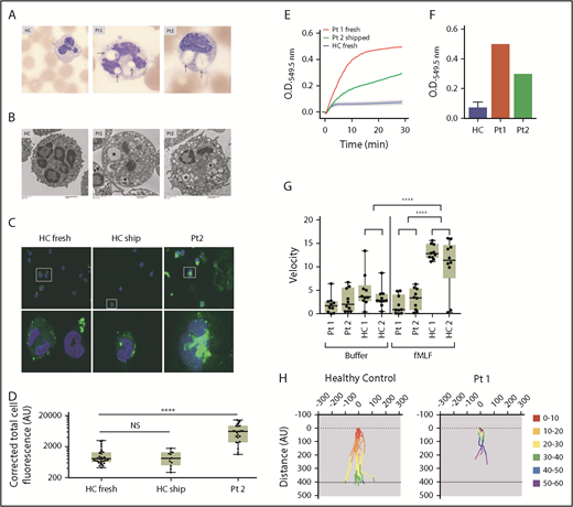 Figure 2. Neutrophils from patients have large macropinocytotic vesicles, excess superoxide production and diminished fMLF-induced chemotaxis. (A) Light microscopy images of blood smears from health control (HC), patient (Pt)1, and Pt2. Large vacuoles are clearly present within the neutrophils of Pt1 and Pt2 (arrows). Images acquired from a CellaVision DM1200. Original magnification ×100. (B) Transmission electron microscopy of neutrophils from HC, Pt1, and Pt2. *Large vacuoles are seen in both patients. Paucity of specific granules in Pt1 compared with HC. Images were acquired using a Hitachi H7600 transmission electron microscope and an AMT XR41B digital camera. Original magnification of HC and Pt2, ×3000; original magnification of Pt1, ×2500. (C) Neutrophils from HC either fresh (left) or shipped along with the patient sample (middle) and Pt2 (right) were incubated with FITC-dextran for 15 minutes. Cells were fixed and viewed using Images and were acquired using EVOS FL system with ×40 and ×100 magnification and analyzed with ImageJ software to determine the cell area, integrated density, and mean. Corrected total cell fluorescence = integrated density – (area × mean of background readings). (D) Total fluorescence of FITC-dextran cells corrected for background fluorescence. Calculations from 10 to 30 individual cells from each sample were plotted. P values were calculated using 1-way ANOVA correcting for multiple comparisons. ****P < .0001. (E) Neutrophil extracellular superoxide production kinetics measured every 15 seconds after fMLF treatment of cells from Pt1 (red) and Pt2 (green) compared with 6 HCs (blue line with error bars) showing superoxide production over 30 minutes, evaluated every 15 seconds. (F) Cumulative superoxide production after 30 minutes. (G) Net chemotactic velocity of 10 individual cells from patients 1 and 2 compared with 2 HC with buffer alone (left) or fMLF (right). Two-way analysis of variance (ANOVA) correcting for multiple comparisons was used for calculating significance. ****P < .0001. (H) Individual cell tracings from Pt1 (right) and HC (left) tracking movement and colored by 10-minute increments. AU, arbitrary unit; O.D., optical density.