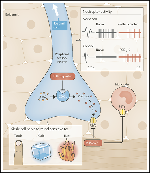 R-flurbiprofen and MRS2578 are 2 novel analgesics for chronic SCD pain. SCD mice exhibit chronic behavioral and neuronal hypersensitivity to mechanical, cold, and heat stimuli. Peripheral administration of the COX-2 inhibitor R-flurbiprofen decreases cold and mechanical behavioral hypersensitivity in SCD mice as well as spontaneous and mechanically-induced nociceptor firing in in vivo recording preparations from SCD mice. In control mice, peripheral application of PGE2-G, a byproduct of COX-2-mediated 2-AG oxidation, increases behavioral mechanical hypersensitivity, induces nociceptor firing, and increases nociceptor responsiveness to mechanical, cold and heat stimuli. Administration of the P2Y6 antagonist MRS2578 decreases the PGE2-G-induced behavioral hypersensitivity in control mice and the naturally-occurring chronic behavioral hypersensitivity observed in SCD mice. Schematic shows the peripheral terminal of the cutaneous nociceptive sensory neuron and that R-flurbiprofen inhibits the COX2-mediated production of PGE2-G which activates the P2Y6 receptor. Alternatively, MRS2578, blocks P2Y6 receptors on either peripheral nerve terminals or monocytes. Inset shows a C fiber nociceptor from SCD mice (top) and control mice (bottom). The SCD C fiber shows significant spontaneous action potential firing (naïve) compared to the control (naïve). R-flurbiprofen reduces the spontaneous action potential firing in the SCD C fiber. The bottom shows that PGE2-G induces action potential firing in the control C fiber. Professional illustration by Neil Smith.