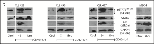 Analysis of AID expression in CLL cells treated in vitro with ibrutinib. (A) MEC-1 cell line was cultured in the presence of ibrutinib at 0.1 and 1 µM for 24 and 48 hours, or in DMSO as control. AID expression at the protein level was evaluated by immunoblotting and flow cytometry techniques. Shown are representative immunoblots (upper graphic) and mean fluorescence cytometry histograms (lower panels), where increasing AID levels are detected for all treated conditions. Proliferation measured by Ki-67 expression was performed at baseline and after 24 and 48 hours of ibrutinib treatment (right graphic). (B) PB CLL cells were incubated in the presence of ibrutinib at 0.3 and 1 µM. DMSO was used as basal control, and CD40L+IL-4 stimulation to induce AID expression was used as positive control (n = 5). AICDA mRNA and protein expression was evaluated at 24 and 48 hours, as indicated in the x-axis. Shown are the results from the whole cohort of patients studied by quantitative qPCR (left graphic) and the immunoblot obtained when studying the 2 patients colored in red and blue (right graphic). AID increase was detected only in the CD40L+IL-4 activated condition for both mRNA and protein determinations. (C) PBMC from 5 patients with CLL were incubated with CD40+IL-4 or CD40+IL-4+ibrutinib 1 μM, and then cultured for 5 days. Proliferation was evaluated by Ki-67 expression, and viability of cells was analyzed by propidium iodide as a life/death marker (upper graphics). As previously described by Slinger et al,44 maximum inhibition of proliferation was achieved after 24 hours. AICDA mRNA levels and AID protein were tested by qPCR and immunoblotting, respectively, at the different times and conditions (lower graphics). Significance was calculated comparing stimulated condition (CD40+IL-4) with stimulated condition + ibrutinib by 2-tailed, paired t-test (*P < .05; **P < .01). (D) PBMC from 3 patients with CLL were incubated in the presence of CD40L+IL-4 in the same conditions as mentioned here. Samples without treatment (RPMI+FBS 10%+DMSO -ctrol-), samples treated with CD40L+IL-4 and samples treated with CD40L+IL-4+1 μM of ibrutinib were tested. Glyceraldehyde-3-phosphate dehydrogenase (load control); AID; STAT6 and p-STAT6-Tyr641 proteins expression were evaluated at day 5. Immunoblots depict the effect of ibrutinib on AID expression and STAT6 phosphorylation. Whereas AID and p-STAT6-Tyr641 decrease during ibrutinib treatment, the nonphosphorylated form of STAT-6 remains unchanged. The same proteins were analyzed in the MEC-1 cell line after incubation with ibrutinib (ibru) or DMSO as control (Ctrol). As depicted, p-STAT6-Tyr641 was undetectable in neither condition, whereas the nonphosphorylated STAT-6 form remains unchanged. As previously described,28 AID expression increased when MEC1 cells are cultured in presence of ibrutinib.