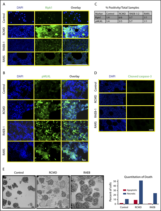 Figure 7. Bone marrow from patients with MDS displays increased Ripk1 and pMLKL and necrotic morphology on electron microscopy. (A) Ripk1 staining on paraffin-embedded human bone marrow aspirate for DAPI and Ripk1. MDS subtypes include (from top to bottom) refractory cytopenia with multilineage dysplasia (RCMD), refractory anemia with excess blasts (RAEB-1), and refractory anemia with ring sideroblasts (RARS). Scale bar, 100 μm. The experiment was performed 3 independent times. (B) Phospho-MLKL staining on paraffin-embedded human bone marrow aspirate. The experiment was performed 2 independent times. Scale bar, 50 μm. (C) Table demonstrating positivity of human samples for Ripk1 and pMLKL by subtype. (D) Cleaved caspase-3 staining on paraffin-embedded human bone marrow aspirate. The experiment was performed 3 independent times. Scale bar, 50 μm. (E) TEM of human bone marrow aspirate following RBC lysis from a normal control donor, an early MDS patient, and a RAEB patient. Scale bars, 2 μm; original magnification ×4400. Quantitation of apoptotic or necroptotic cell death for each patient represented in graph (right).