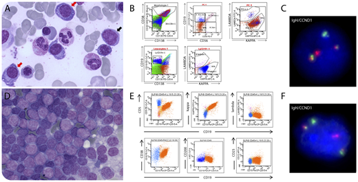 During the diagnostic workup of a 72-year-old man with anemia (83 g/L) with increased free κ light chain (140 mg/L), a bone marrow smear revealed infiltration by 25% of plasma cells (panel A, red arrows; original magnification ×60, May-Grünwald-Giemsa stain) together with rare atypical lymphoid cells (panel A, black arrow). Flow cytometry revealed, by fluorescent in situ hybridization, monotypic κ light chain–restricted plasma cells (CD38+, CD56+, CD19−) (panel B) that harbor the t(11;14)(q13;q32) translocation on sorted CD138 cells (panel C); atypical lymphoid cells also had κ monotype (panel B). Given the spontaneous improvement of the anemia, a watch-and-wait strategy was adopted. During the first year of follow-up, a splenomegaly developed, with moderate uptake (standardized uptake value, 5.63) on positron emission tomography, and splenectomy was performed. The spleen was infiltrated by small B cells (panel D; original magnification ×40, May-Grünwald-Giemsa stain) with the immunological profile of mantle cell lymphoma (CD5+, CD23−, CD200−, κ monotype) (panel E), which was confirmed by histology and the detection of the t(11;14)(q13;q32) translocation (panel F). No treatment was initiated. / This case illustrates the synchronous association of a mantle cell lymphoma and a myeloma expressing the same light chain and exhibiting the same t(11;14) translocation, suggesting a common origin of these 2 components from the same B-cell clone. Molecular analysis for the immunoglobulin heavy chain rearrangement could confirm the common origin, as previously described in literature.