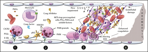 Figure 3. Proposed mechanism of NET-dependent thrombosis in vivo. (1) Neutrophils adhere to the endothelium by interaction between E-selectin and neutrophil P-selectin glycoprotein ligand (PSGL) and CXCR2. Platelets (PLTs) adhere by binding to von Willebrand factor (VWF) attached to the endothelium. (2) PSGL-1 and CXCR2 signaling in neutrophils (PMNs), as well as interactions between adherent neutrophils and platelets mediated by platelet HMGB1 or P-selectin, promote NET release. (3) NETs adhere and damage the vascular wall, impair flow, trap circulating procoagulant actors, impair physiologic anticoagulants, (4) ultimately leading to enhanced coagulation and thrombosis. aPTL, activated platelet; E-SEL, endothelial selectin; NE, neutrophil elastase; PMV, procoagulant microvesicle; TFPI, TF pathway inhibitor.