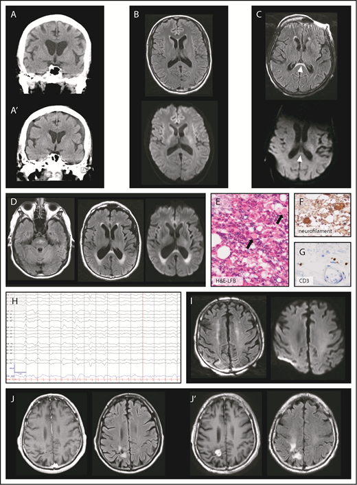 Figure 2. Brain imaging and electroencephalography during neurotoxicity. (A) Normal CT of the brain at onset of neurotoxicity (top) and subdural hematoma 13 days later (A′). (B) Axial MRI of the brain with normal FLAIR (top) and diffusion-weighted imaging (DWI, bottom) sequences during acute neurotoxicity. (C) Axial FLAIR image (top) in a patient with severe neurotoxicity demonstrating a lesion (arrowheads) of the splenium of the corpus callosum partly characterized by restricted diffusion on DWI sequences (bottom). (D) Axial FLAIR hyperintensities of the brainstem (left) and the periventricular white matter (middle) were found in a patient with left-sided visual field deficit who presented 30 days after CAR T-cell infusion. Periventricular lesions were characterized by restricted diffusion on DWI sequences (right). Luxol fast blue (LFB) with hematoxylin and eosin (H&E) (E), neurofilament (F), and CD3 (G) stains of a tissue specimen taken from the periventricular lesion in panel D shows axonal injury of the optic radiation (original magnification, ×400). H&E-LFB demonstrates vacuolization and axonal spheroid formation (arrows). Immunohistochemical staining for neurofilament shows enlarged circular brown material consistent with axonal spheroids within white matter, a finding characteristic for Wallerian degeneration. Immunohistochemical staining for CD3 highlights T cells in scant numbers, primarily present in perivascular regions. (H) Electroencephalography of a patient who developed myoclonus and confusion 10 days after CAR T-cell infusion. Low-frequency blunted generalized periodic discharges admixed with rhythmicity on an alternating background between δ and θ slowing are displayed. The snapshot is seen in a longitudinal bipolar montage (left-right-left-right-midline): sensitivity, 7 μV/mm; time base, 30 mm/s; low-frequency filter, 1 Hz; high-frequency filter, 70 Hz; and notch, 60 Hz. (I, left) Axial FLAIR image in a patient with confusion after rituximab-lenalidomide infusion shows bilateral curvilinear hyperintensities in the juxtacortical frontoparietal white matter without restricted diffusion on DWI sequences (right). (J) Axial T1-weighted MRI postcontrast and FLAIR images demonstrate a radiosurgery lesion pre-CAR T-cell infusion (left) and evidence of radiation necrosis with contrast enhancement after CAR T-cell infusion (J′).