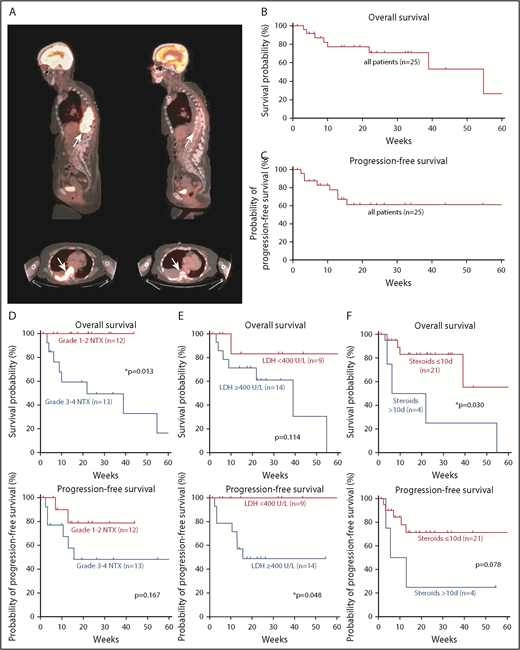 Figure 3. Prognostic markers for survival and disease progression in patients with neurotoxicity. (A) Sagittal and axial positron emission tomography-CT images show a paraspinal mass (arrows) with high-intensity contrast uptake consistent with lymphoma (left) and complete response 1 month after CAR T-cell infusion (right). Kaplan-Meier estimates of overall survival (B) and progression-free survival (C) in our cohort. Tick marks indicate censored patients. Kaplan-Meier estimates of overall survival and progression-free survival for different prognostic markers. Curves are given for patients with low- or high-grade neurotoxicity (D), LDH <400 U/L or ≥400 U/L at CAR T-cell infusion (E), and ≤10 or >10 days of steroid use (F). Tick marks indicate censored patients.