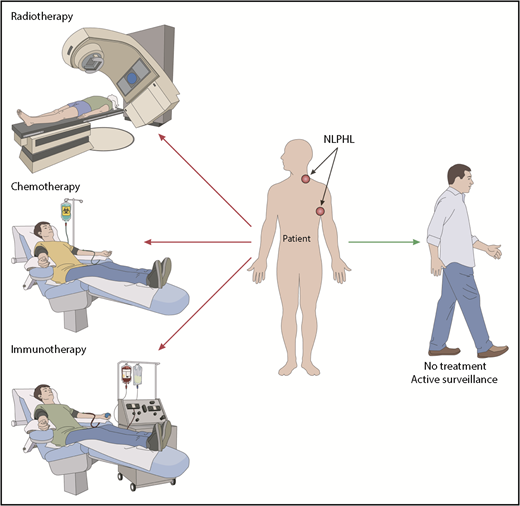Nodular lymphocyte predominant Hodgkin lymphoma: therapeutic choices. Professional illustration by Patrick Lane, ScEYEnce Studios.