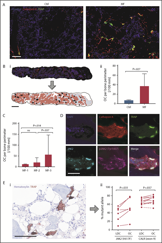 Figure 1. In situ analysis of normal and MF BM biopsy OCs. (A) Representative images of BM tissue from healthy controls (Ctrl; n = 3) and MF patients (n = 50) stained for TRAP and cathepsin K, with Hoechst 33258 as nuclear counterstain. As shown, few OCs are detected in normal BM biopsies, whereas abundant numbers of OCs are detected in the BM of MF patients. (B) Representative BM biopsy image (i) and OC quantitation (ii) in tissue sections from normal Ctrl and MF patients. Depicted BM section was stained for TRAP (green) and cathepsin K (red), with Hoechst 33258 as nuclear counterstain (blue). Whole-tissue image was assembled from 81 spectrally unmixed fields taken at a magnification of ×200, and a phenotype map of specimen was generated by a pattern-recognition algorithm. Red areas represent cellular BM, gray areas outline bone, and asterisks denote individual OCs. Bars represent median with 95% confidence interval (CI). (C) Comparison of OC numbers and BM fibrosis grade. As shown, MF patients with advanced-stage fibrosis (MF-3; n = 27) have higher numbers of OCs compared with patients with MF-1 (n = 4) and MF-2 (n = 13). BM fibrosis was independently graded using the European consensus criteria by pathologists who analyzed the patients’ BM biopsy specimens. Bars represent median with 95% CI. (D) A representative image of BM biopsy sections obtained from MF patients with a JAK2V617F mutation (n = 5). BM biopsy sections were immnuostained with antibodies against TRAP, cathepsin K, and total and phosphorylated (p) JAK2 protein. The cells’ nuclei were counterstained with 4′,6-diamidino-2-phenylindole (DAPI). Images depict multiple OCs along thickened bone trabecula expressing high levels of pJAK2. At the time of biopsy, the patients’ peripheral blood JAK2V617F allele burden was 75.65%. (E) Analysis of randomly microdissected single OCs. (i) Representative image of BM biopsy sections obtained from CALR-mutated MF patients (n = 10) stained with anti-TRAP antibodies and hematoxylin QS nuclear counterstain. Dashed lines denote individual TRAP+ cells that were captured from the BM tissue sections by immunoguided laser microdissection. (ii) JAK2V617F (n = 6) and CALR exon 9 mutation (n = 10) allele burden in circulating low-density cells (LDC) and OCs randomly microdissected from the BM of mutation MF patients harboring 1 of those mutations. As shown, most single microdissected OCs expressed a higher mutant allele burden than LDC. Dashed lines denote samples with a decrease in allele burden. γ correction was not applied. Bars represent 100 μm (A,D,Ei) and 1 mm (Bi). ns, not significant.