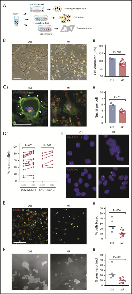 Figure 2. Characterization of monocyte-derived cultured OCs. (A) Schematic diagram of OC characterization studies. Top arrow: fractionated CD14+ monocytes were cultured in the presence of macrophage colony-stimulating factor (M-CSF) and RANKL. Cultured OCs were analyzed after 3 weeks. Middle arrow: cell fusion assay was carried out by culturing CD14+ monocytes labeled with either red or green lipophilic dyes at a 1:1 ratio. Bottom arrow: bone resorption assay was performed after CD14+ monocytes were cultured for 3 weeks in the OC culture assay on top of a bone mineral–coated surface. All experiments were performed in duplicate. Average values are depicted. (B) Morphological analysis of cultured OCs. (i) Representative phase-contrast images of mature OCs derived from CD14+ monocytes of healthy donors (Ctrl; n = 3) and MF patients (n = 12). Compared with Ctrl OCs, MF OCs are smaller and rounder, with almost no protrusions. (ii) Quantitative analysis of OC diameter. Dots represent average values for 500 cells from each patient. Bars denote median. (C) Assessment of OC nuclei. (i) Representative images of Ctrl’s (n = 3) and MF patients’ (n = 12) OCs stained with F-actin dye, anti-TRAP antibody, and 4′,6-diamidino-2-phenylindole (DAPI) nuclear counterstain. Compared with normal OCs, MF OCs are characterized by fewer nuclei and abnormal F-actin ring (arrowheads) formation. (ii) Quantitation of cultured OCs shows a reduced number of nuclei in MF OCs. Dots represent average values for 500 cells from each patient. Bars denote median. (D) Clonal analysis of MF OCs. (i) Allele burdens of JAK2V617F (n = 15) and CALR exon 9 mutation (n = 6) in low-density cells (LDC) and OCs cultured from MF patients carrying a JAK2V617F or CALR exon 9 mutation. As shown, OCs carried a higher allele mutant burden than circulating LDC. Dashed lines denote samples with a decrease in allele burden. (ii) Fluorescence in situ hybridization analyses confirm that MF OCs are derived from the neoplastic clone. Shown are representative images (×100 magnification) of cultured OCs from MF patients with 13q and 20q deletions (n = 4). Individual chromosomes were stained using 1, 16, 13q, and 20q probes, and nuclei were counterstained using DAPI. Nuclei of MF OCs lack 1 long arm of chromosome 13 or 20 (nuclei showing only 1 red dot). Chromosomes 16 and 1 were used as internal controls (2 green dots). (E) Cell fusion capacity of OC-forming monocytes. (i) Representative images of OCs cultured from 2 populations of CD14+ monocytes from Ctrl (n = 5) and MF patients (n = 12). Membranes of live cells were stained using lipophilic dyes PKH26 and PKH67. A smaller number of cells harboring both dyes (yellow), indicating decreased cell fusion, is seen in MF patient–derived cells. (ii) Quantitation of cells with colocalization signals. Horizontal lines denote median. (F) Bone mineral resorption capacity of cultured OCs. (i) Representative images of OCs grown on top of bone mineral–coated surface from Ctrl (n = 4) and MF patients (n = 8). Cultured MF OCs exhibit a significant decrease in the total resorbed area (white). (ii) Quantitation of the resorbed mineral-coated surface areas. Horizontal lines denote median. No γ correction was applied. Bars, 200 µm.