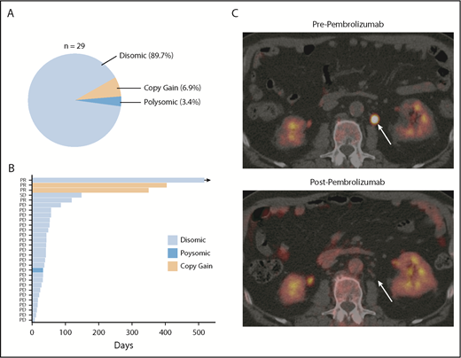 Figure 5. PD-L1 gene alterations are associated with objective response following pembrolizumab treatment in relapsed/refractory DLBCL patients. (A) Incidence and mechanism of PD-L1 gene alterations among 29 DLBCL patients enrolled on the KEYNOTE-013 study of pembrolizumab. (B) Swimmer’s plot demonstrating response characteristics and PFS to pembrolizumab according to PD-L1 locus status. Arrow depicts ongoing response. (C) Positron emission tomography (PET) scan images before and after pembrolizumab treatment in a patient with a PD-L1 gene–amplified DLBCL prior to and following 4 cycles of pembrolizumab treatment. PD, progressive disease; PR, partial response; SD, stable disease.