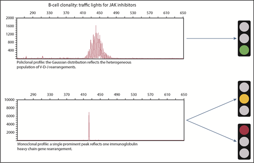 Immunoglobulin rearrangements and therapeutic decisions regarding treatment with JAK inhibitors.