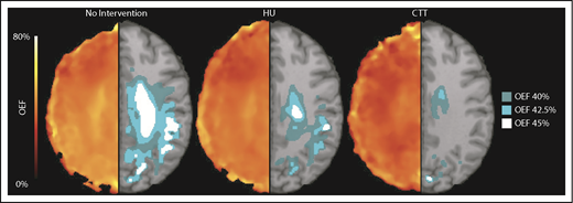 Figure 2. HU decreases the volume of brain tissue with elevated OEF in the border zone. The average white matter OEF map for each cohort was thresholded at 40% (dark teal), 42.5% (light teal), and 45% (white) OEF to identify the brain regions with peak oxygen metabolic stress, as a potential index of elevated stroke risk. The figure shows the average OEF map for each cohort (left), paired with the thresholded regions overlaid on a T1 atlas (right). There is a decrease in thresholded brain tissue in the cohort treated with HU when compared with those not receiving disease-modifying therapy across all thresholds, but the cohort receiving CTT has a significantly lower volume of at risk tissue compared with the HU cohort.