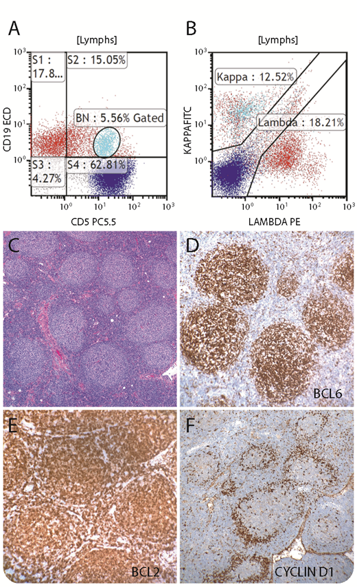 A 76-year-old man with a recent diagnosis of prostate carcinoma was found to have extensive lymphadenopathy, including the axillary region and mediastinum. Flow cytometry of axillary lymph node (LN) demonstrated 2 clonal B-cell populations: 1 small population was CD19+/κ+/CD5+/dim CD20+/CD23−/ FMC7−/CD10− (light blue, panels A-B), and a larger population was CD19+/λ+/CD5−/FMC7−/CD23+/CD20+/CD38+/CD10− (red, panels A-B). The LN showed effacement of the architecture by a nodular infiltrate of small cleaved lymphocytes with extracapsular extension (panel C; original magnification ×100; hematoxylin and eosin stain). Centroblasts were rare. CD21 stain highlighted the prominent follicular pattern of the infiltrate, and the infiltrate was CD20+/CD79a+/PAX5+/CD10 weak+/BCL6+ (panel D; original magnification ×200)/BCL2+ (panel E; original magnification ×200)/CD5−/CD23 weak+/cyclin D1−/Ki-67 (20%), consistent with follicular lymphoma, grade 1-2. Interestingly, rare lymphoid follicles showed a population of cyclin D1+ cells colonizing the mantle zone (panel F; original magnification ×100), consistent with in situ mantle cell neoplasia. Bone marrow and gastric biopsies showed involvement by follicular lymphoma. Evidence of mantle cell lymphoma was not identified. / In situ mantle cell neoplasia is rare and can be associated with other lymphomas. It is usually an incidental finding that is only unveiled by flow cytometry and immunohistochemistry studies. The course is indolent. Only rare cases progress to overt lymphoma. This case emphasizes the importance of utilizing multiple tools in the lymphoma diagnosis.
