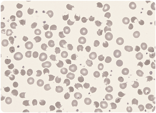 A 19-year-old man presented to the emergency department having taken an overdose of medications. On examination he was agitated and tachycardic and appeared icteric with central cyanosis. Pulse oximetry indicated an oxygen saturation of 86%, which did not improve with high-flow oxygen therapy. The full blood count showed hemoglobin 91 g/L, white blood cells 12.3 × 109/L, platelets 341 × 109/L, and reticulocytes 295 × 109/L. The blood film showed very prominent bite cells (keratocytes), with some red cells showing multiple bites (May-Grunwald Giemsa stain; original magnification ×500). An acute oxidant-induced hemolysis was considered, and the blood methemoglobin level was 30.8% (normal < 2%). A subsequent G6PD assay was normal. On further questioning, he admitted to taking a cocktail of drugs, including 5.6 g of dapsone, which was missing from his grandmother’s medicine supply. / Dapsone (diaminodiphenyl sulfone) is a compound that has antibiotic, antiparasitic, and anti-inflammatory properties; it has been used for many years in clinical medicine at doses of 50 to 100 mg daily. Even at these doses it can cause a mild chronic oxidative hemolysis. The amine metabolites of dapsone are capable of oxidation of heme iron, resulting in acquired methemoglobinemia and hemoglobin denaturation forming Heinz bodies. These precipitates are removed by splenic macrophages, forming bite cells that are readily identified in the blood film. The persistent hypoxemia, despite oxygen therapy, is an important finding in methemoglobinemia. He was treated with IV methylene blue, blood transfusion, and supportive care and made a full recovery.