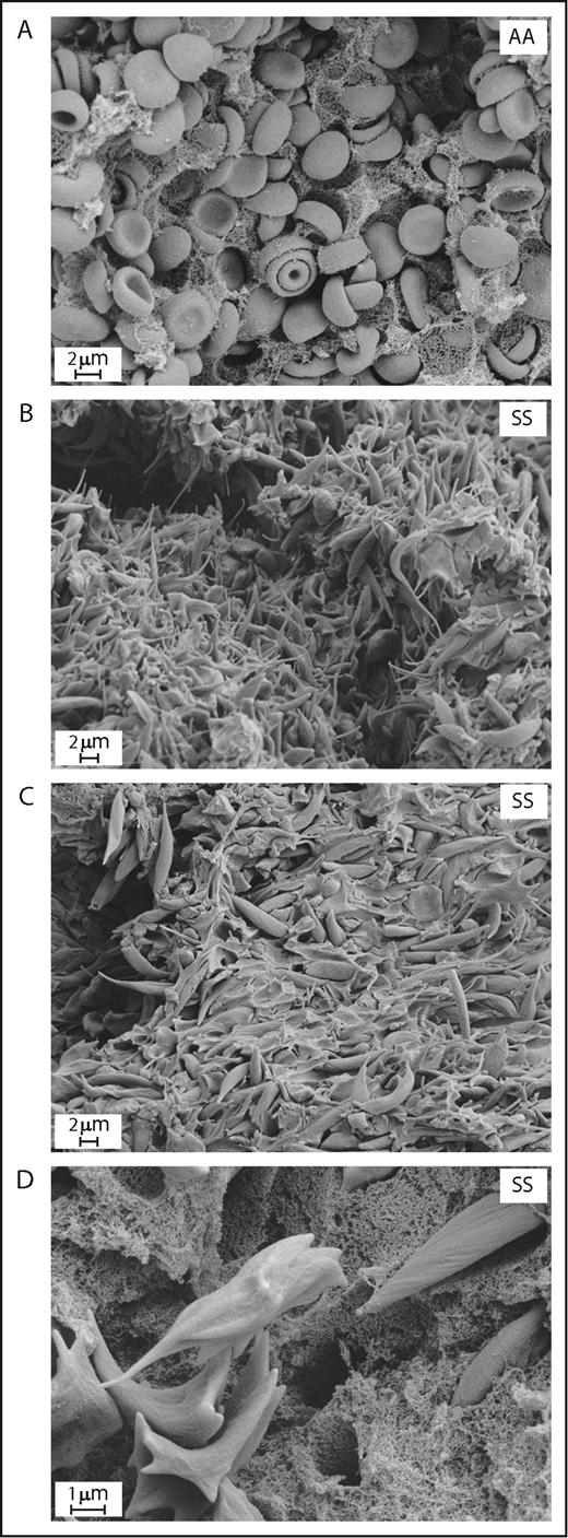 Figure 1. Sickling of RBC and increased deposition of acellular material within venous thrombi formed in SCD mice. Scanning electron microscopy of clots formed 2 hours after inferior vena cava stenosis in AA (A) and SS mice (B-D). Original magnification: ×8000 (A), ×5000 (B-C), and ×20 000 (D).