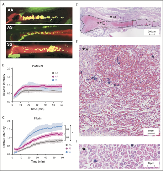 Figure 2. Increased fibrin deposition and evidence of RBC sickling in thrombi formed in the femoral vein of SCD mice. (A) Representative images of platelet (green) and fibrin (red) deposition within thrombi formed in the femoral vein of AA, AS, and SS mice 60 minutes after electrolytic injury. Yellow color shows overlap between fibrin and platelets. Representative movies demonstrating the dynamics of clot formation over 1 hour are included as supplemental Videos 2-4 for AA, AS, and SS mice, respectively. Intravital microscopy analysis of platelet accumulation (B) and fibrin deposition (C) within thrombi of AA (n = 14, gray line), AS (n = 9, purple line), and SS (n = 10, blue line) mice quantitated as a relative intensity. *P < .05. (D) Hematoxylin and eosin staining of the thrombus (delineated by black dotted line) formed in the femoral vein of SS mice demonstrates the presence of RBCs (dark pink) and fibrin/platelets (light pink). Extensive sickling of the RBCs is present within the thrombus (E) but not in the blood pool outside the thrombus (F). Original magnification: ×4 (D) and ×40 (E-F). NS, not significant.