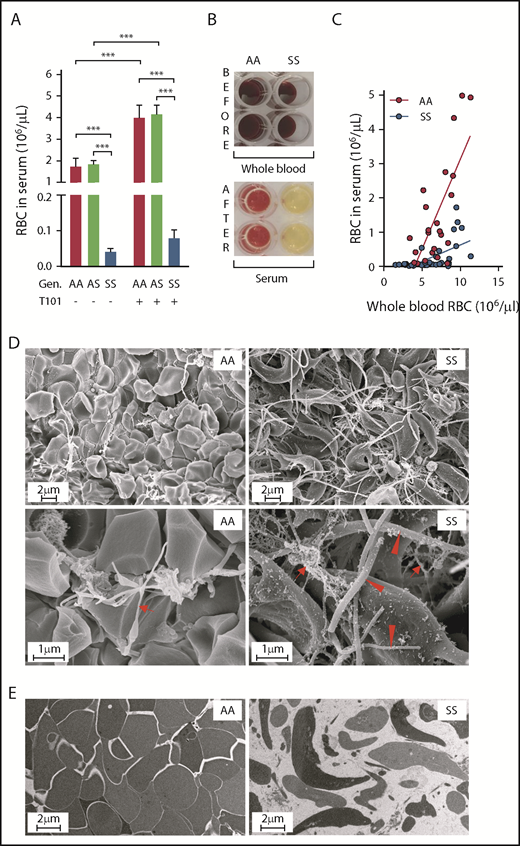 Figure 3. Inhibition of clot contraction-mediated extrusion of mouse sickle RBCs from whole blood clots formed ex vivo. (A) Number of RBCs released from clots formed ex vivo from the blood of AA (n = 15), AS (n = 10), and SS (n = 16) mice in the absence (−) or presence (+) of FXIIIa inhibitor T101 (20 µM). ***P < .001. (B) Representative images of whole blood (before initiation of clot formation) and serum (after removal of clots formed for 2 hours). Yellow color of SS serum indicates sparse RBC presence. (C) Effect of changes in hematocrit on the serum RBC content 2 hours after contraction of the clot formed from the blood of AA (n = 9) and SS (n = 11) mice. (D) Scanning electron micrographs of ex vivo whole blood clots. Arrows indicate fibrin, arrowheads indicate sickled RBC processes. Original magnification: ×10 000 (upper) and ×40 000 (lower). (E) Transmission electron micrographs of clots formed ex vivo from the blood of AA and SS mice. Original magnification ×10 000. Gen, genotype.