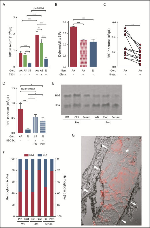 Figure 5. RBC retention in sickle whole blood clots is mediated, in part, by reduced RBC deformability, and can be partially reversed by FXIIIa inhibition or RBC exchange. (A) Number of RBCs released from clots formed ex vivo from the blood of AA subjects (n = 20), AS (n = 13), and SS patients (n = 29) in the absence (−) or presence (+) of FXIIIa inhibitor T101 (20 µM). (B) Effects of glutaraldehyde (0.1%) on AA RBC (n = 6) deformability compared with the deformability of AA (n = 6) and SS (n = 5) RBCs incubated with cold isotonic buffer at 3 Pa. (C) Serum RBC content after clot contraction performed with PRP reconstituted with AA RBCs exposed to isotonic buffer or 0.1% glutaraldehyde (n = 13). (D) Number of RBCs released from clots formed ex vivo from blood obtained from AA control subjects (n = 8), SS patients (n = 11), or SS patients undergoing RBC Ex pre- and postprocedure (n = 10). Representative gel (E) and analysis of hemoglobin content (F) in the WB, clots, and serum obtained from pre- and postexchange samples (n = 5). (G) Representative image of the clot formed in the femoral vein of SS mice (n = 4) injected with AA RBCs. Arrowheads point to the vessel wall; asterisk indicates the clot; red staining demonstrates the presence of AA RBCs within the clot. *P < .05, **P < .01, ***P < .001. Ex, exchange; gluta, glutaraldehyde; WB, whole blood.